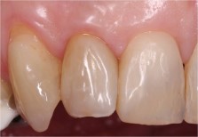 Verfärbte Zähne nach Bleaching