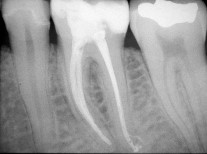 Röntgenbild nach Wurzelkanal-Behandlung